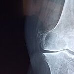 Buy, Hold or Sell Flexion Therapeutics?