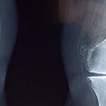 Bone Health Basics