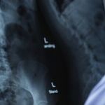 Don't Assume Your Kidneys Are Fine