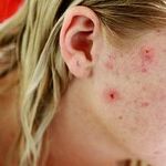 What Can I Do to Get a Clear Complexion?